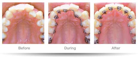 lingual braces Archives - First impression